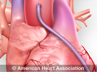 illustration of CABG