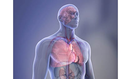 CKM Syndrome illustration